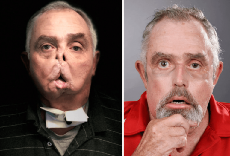 Canada’s First Successful Face Transplant Offers New Hope to Patients