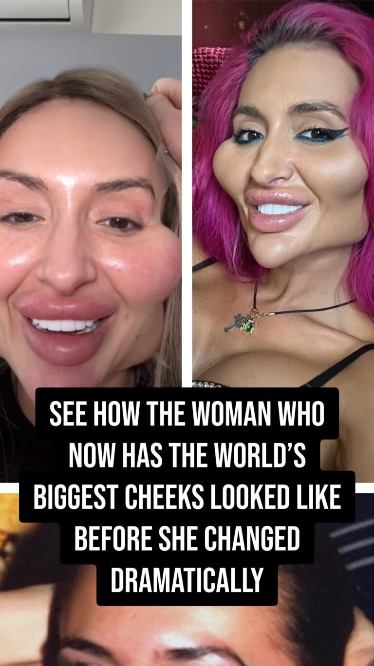 Transformation of the Woman with the World’s Largest Cheeks: A Before and After Look