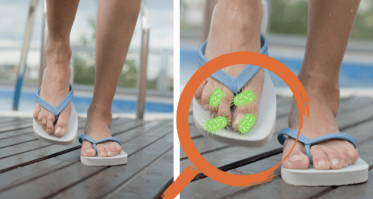 The Perils of Wearing Flip-Flops: A Health Perspective