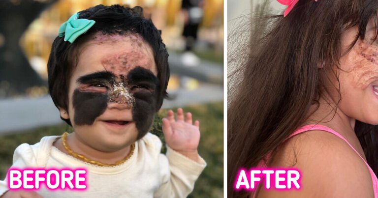A Young Girl Named “Monster” Over Her Birthmark Becomes a Beacon of Hope